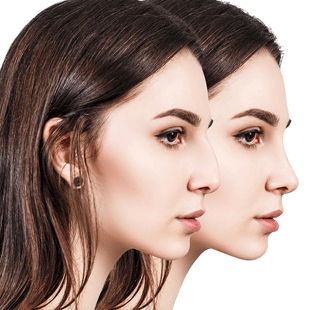 rhinoplasty consult cta