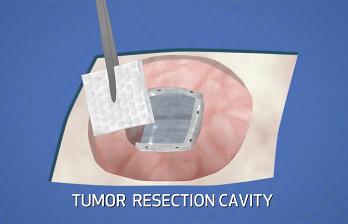 precise-radiation-video-call-out-image