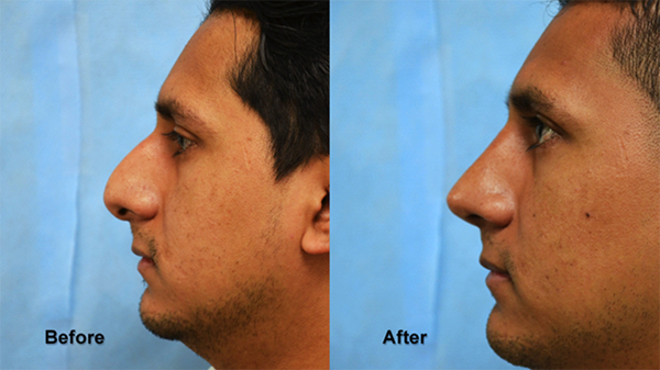 deeb rhinoplasty 2