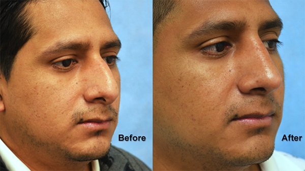 deeb rhinoplasty 3