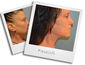 facelift2