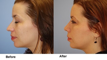 jones rhinoplasty 6
