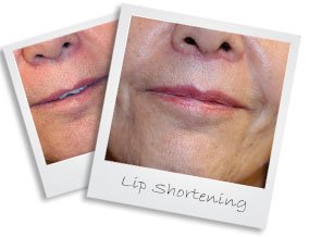 lipshorteningsmall