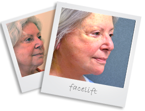 polaroid facelift
