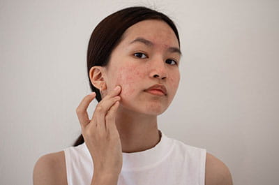 gut acne