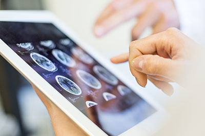 AI and stroke