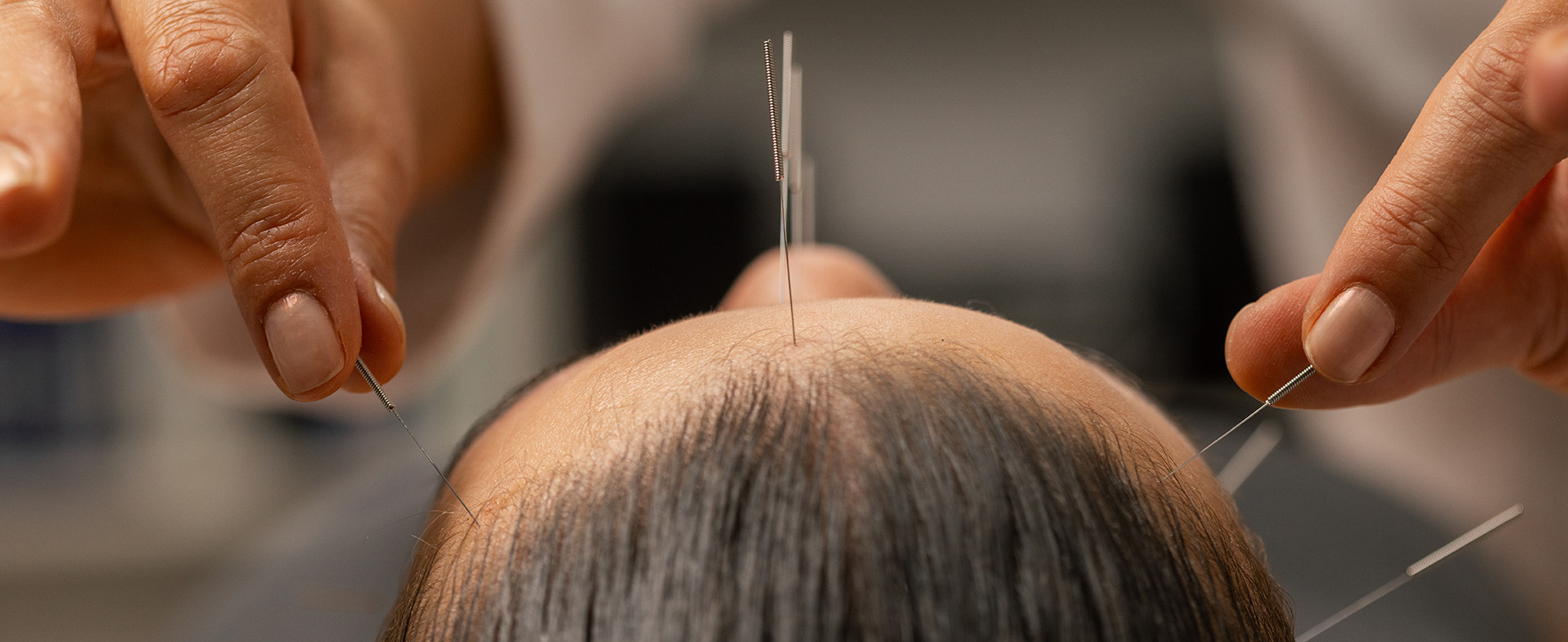 Close up image of acupuncturist placing needles on woman's head and forehead. dummy desktop Image
