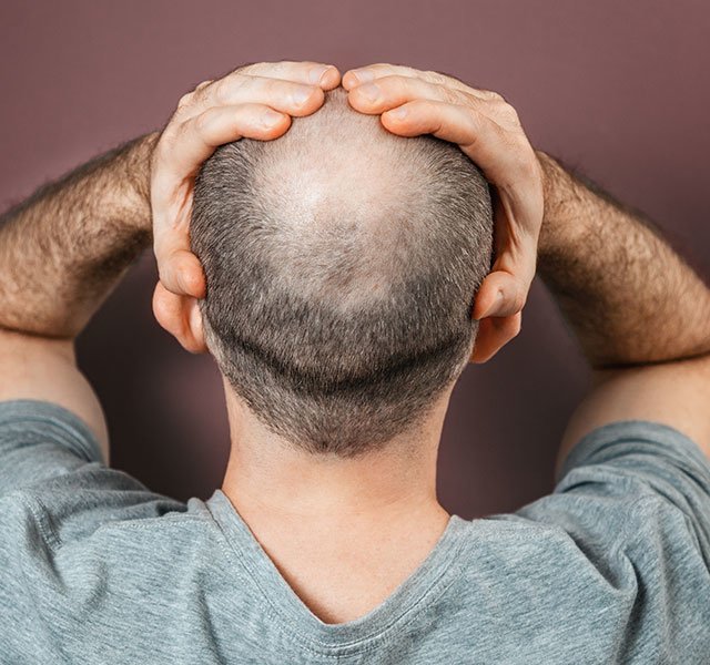male pattern baldness