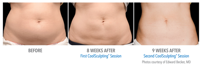 body coolsculpting patient