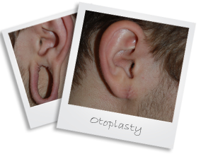 otoplasty2