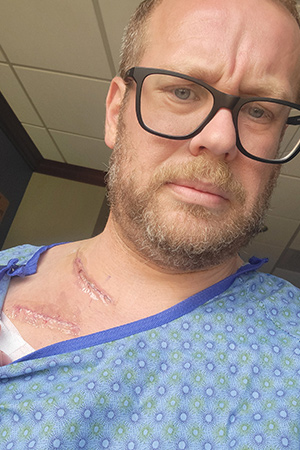 vascular patient Eric showing his scar post-surgery