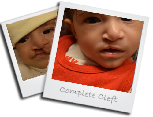 Complete Cleft