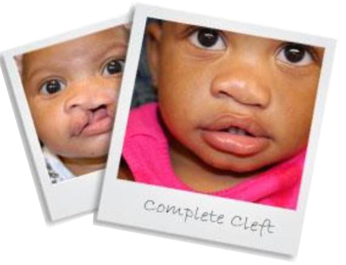 patient10completecleft