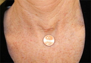 Endo Minmal Invasive Thyroid Scar