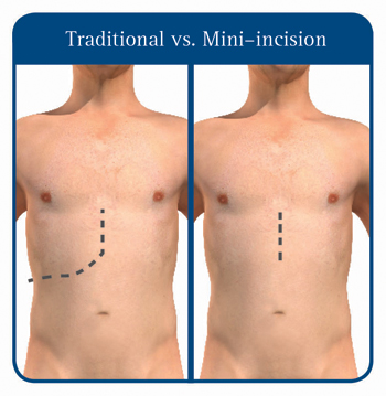 liver surgery incision