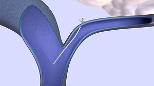 A small shunt called the eShunt System